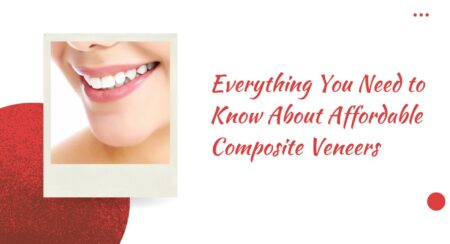 Everything You Need to Know About Affordable Composite Veneers